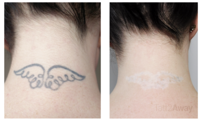 Cosmetic Tattoo Removal